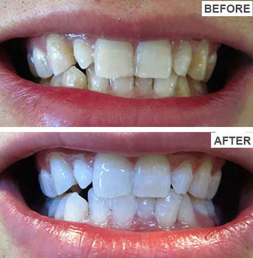 Teeth Whitening Teeth Whitening