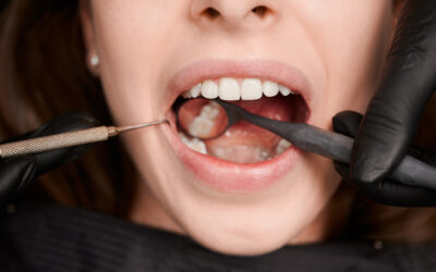 Can You Reverse Early Tooth Decay? Myth vs Reality